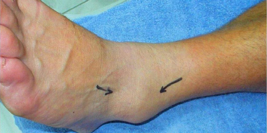 Can Plantar Fasciitis Cause Ankle Swelling